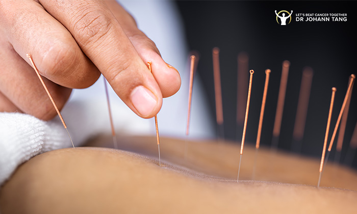 Can Acupuncture Help Ease Pain and Discomfort During Cancer Treatment?